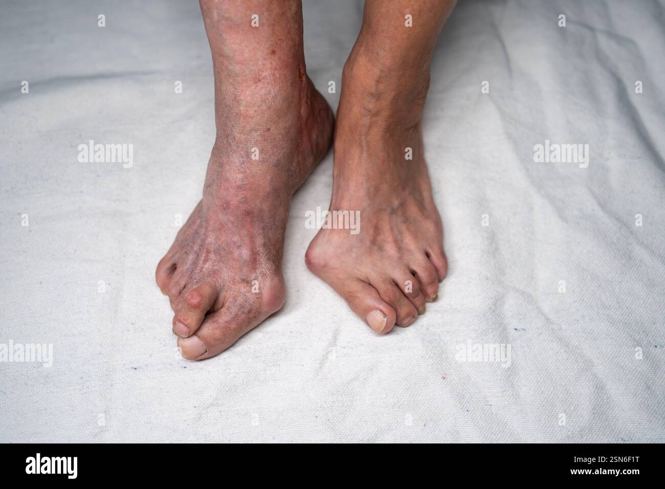Füße einer älteren Frau mit sichtbarer Wirkung von Bunion und Hallux valgus, mit Deformität des MTP-Gelenks, das Grosszehe mit Fuß verbindet. Gemeinkosten-Nahaufnahme der Bedingung Stockfoto