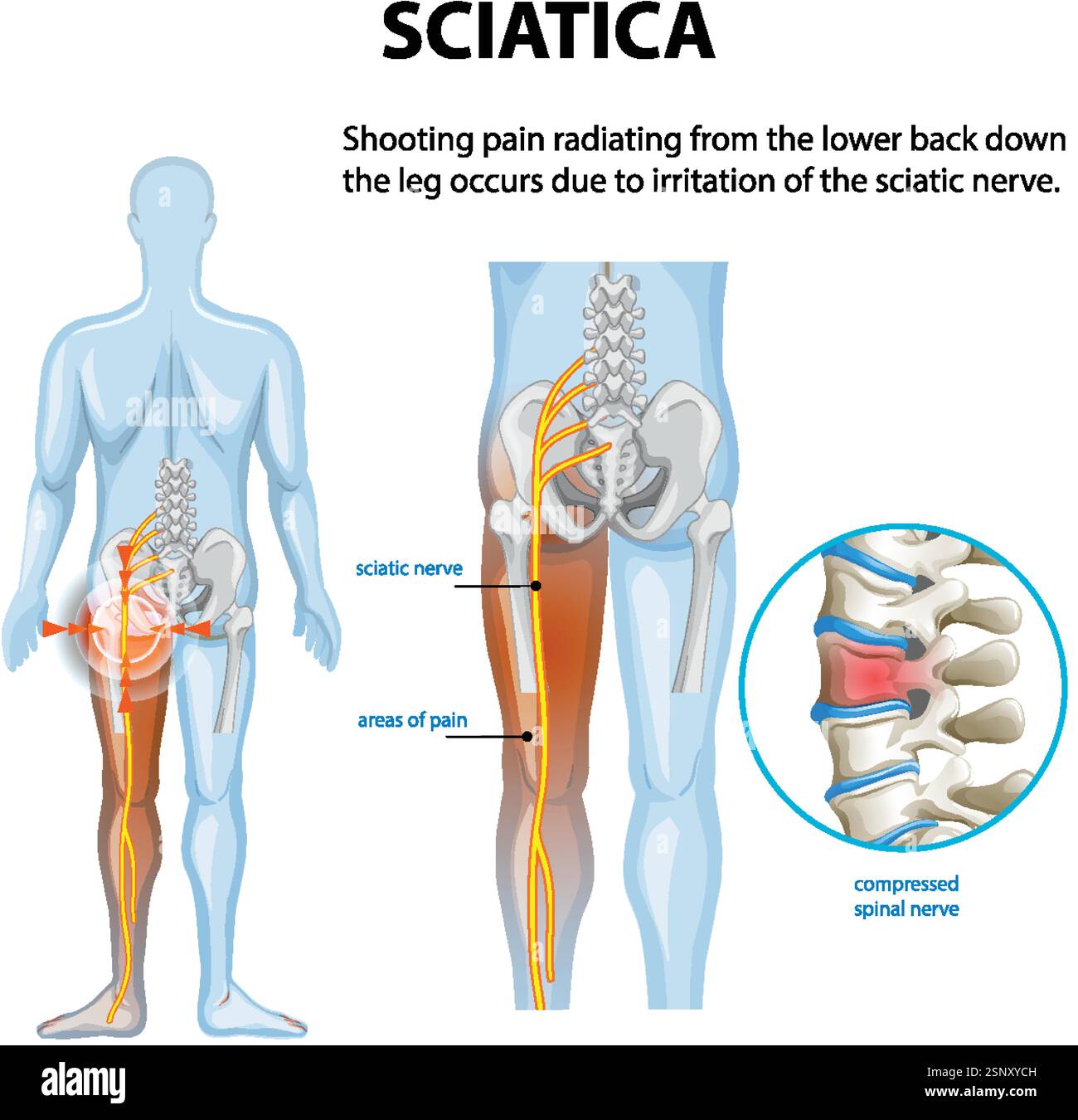 Illustration von Ischiasschmerzen und betroffenen Bereichen Stock Vektor