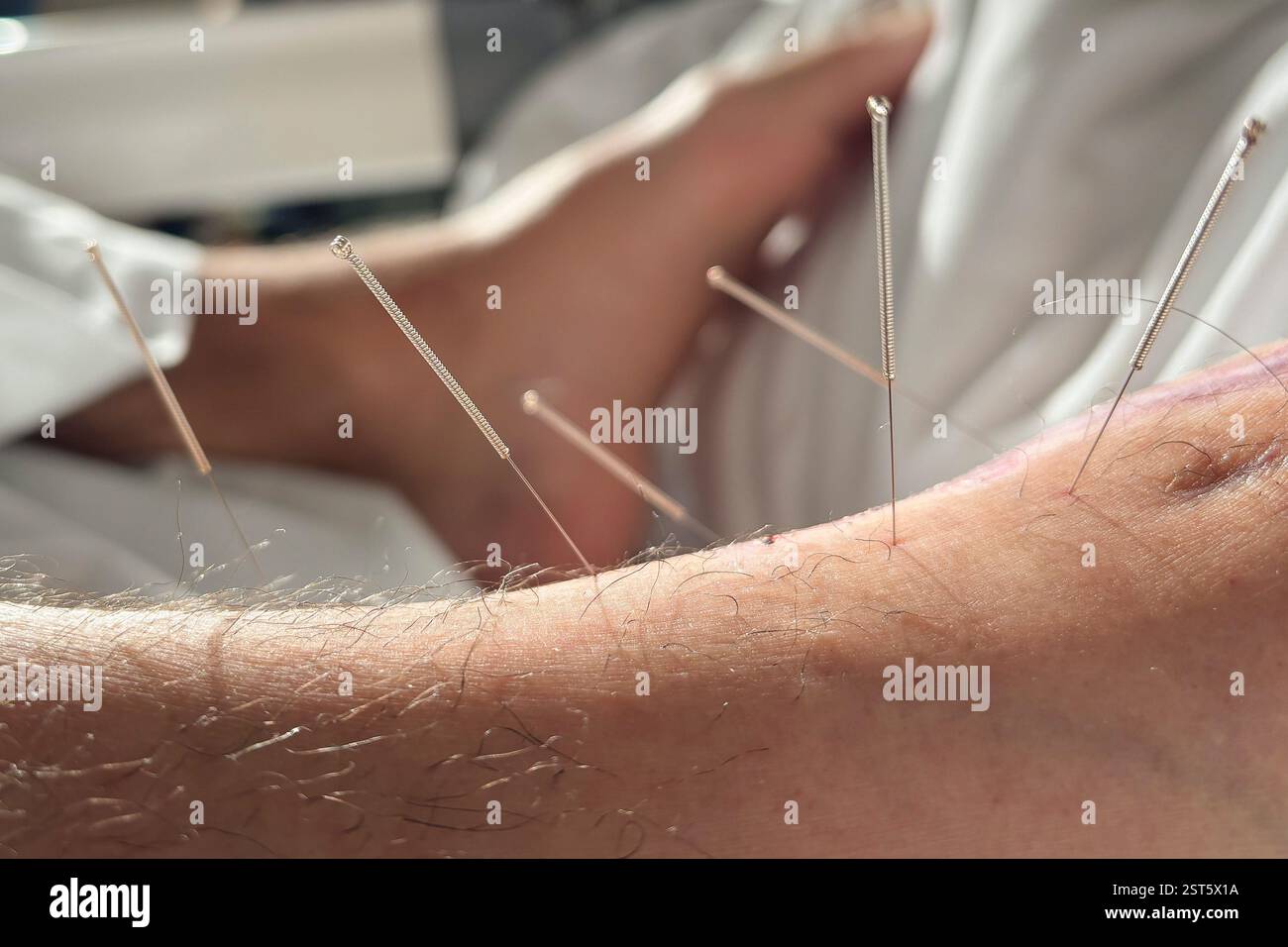 Akupunkturnadeln im Fuß zur Wundheilung Stockfoto