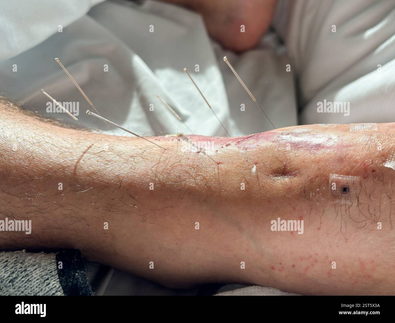 Akupunkturnadeln im Fuß zur Wundheilung Stockfoto