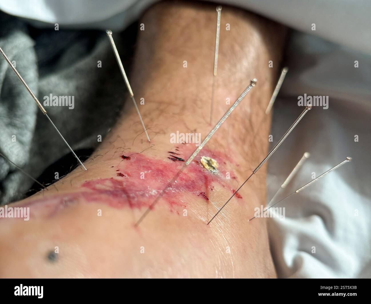 Akupunkturnadeln im Fuß zur Wundheilung Stockfoto