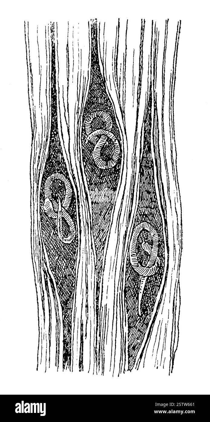 Junge Trichinella spiralis wanderte in die Muskelfasern ein. Illustration des 19. Jahrhunderts. Deutsch Stockfoto