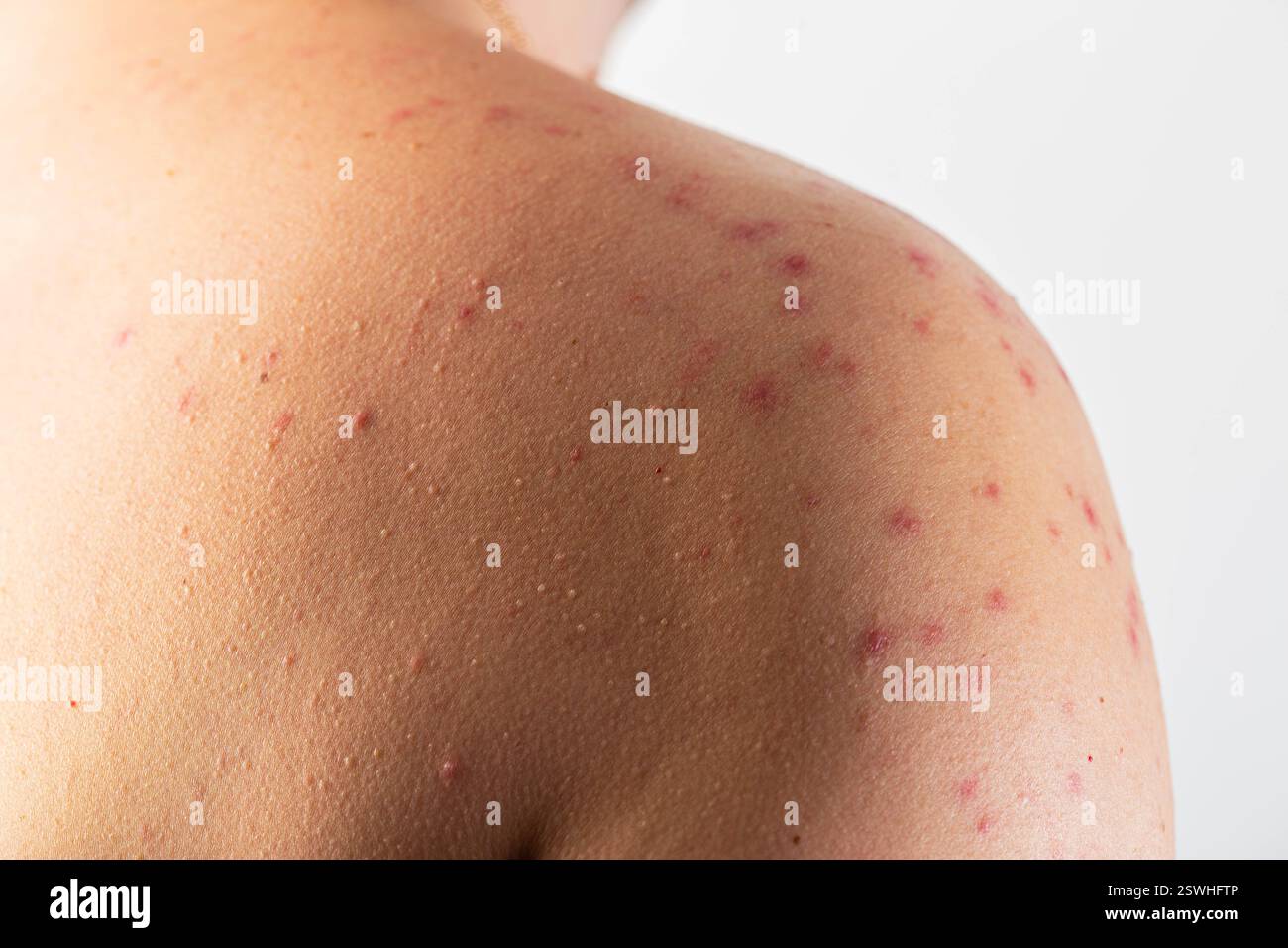 Rote Flecken und Hautausschläge auf der Haut des Rückens und der Schultern nach Alkoholkonsum. Anaphylaktischer Schock, Alkoholintoleranz. Alkoholische Urtikaria und AT Stockfoto