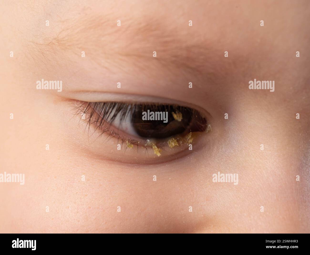 Schnitt und Schmerzen im Auge eines kleinen Jungen, Eiter im Auge. Bakterielle und virale Infektion, Konjunktivitis. Stockfoto