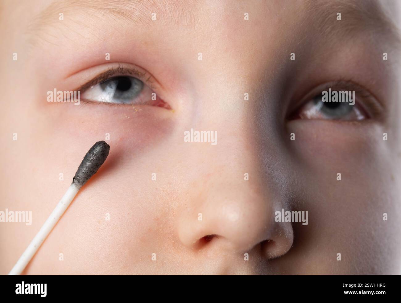 Ein Wattestäbchen vor dem Hintergrund eines Mädchenauges, um den Erreger der Augenentzündung für Infektionen und Bakterien zu untersuchen. Auswahl von Antibi Stockfoto