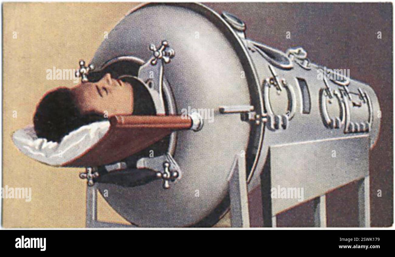 Eine Zigarettenkarte mit einer Person in einer eisernen Lunge. Stockfoto