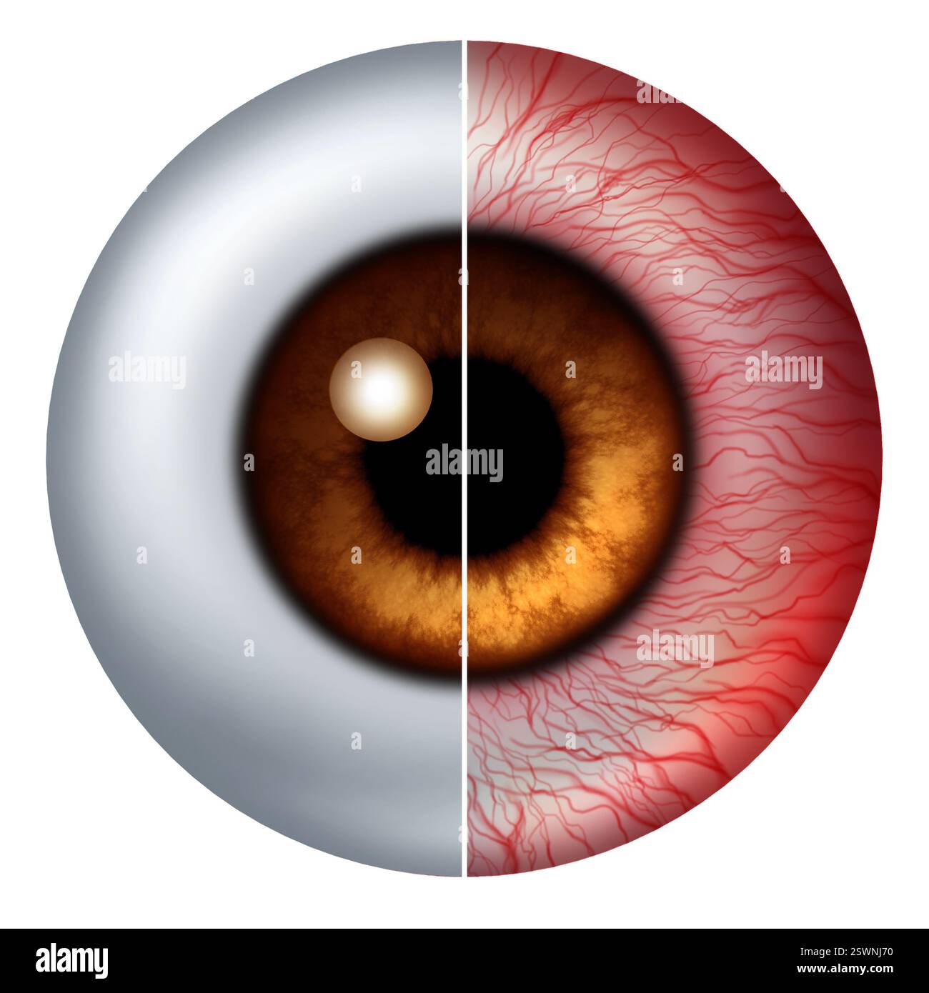 Konjunktivitis Augenkrankheit als gesunder und infizierter roter Augapfel als Ophthalmologie- oder Optikermedizinisches Diagnosekonzept als menschlicher Augapfel-infiziert Stockfoto