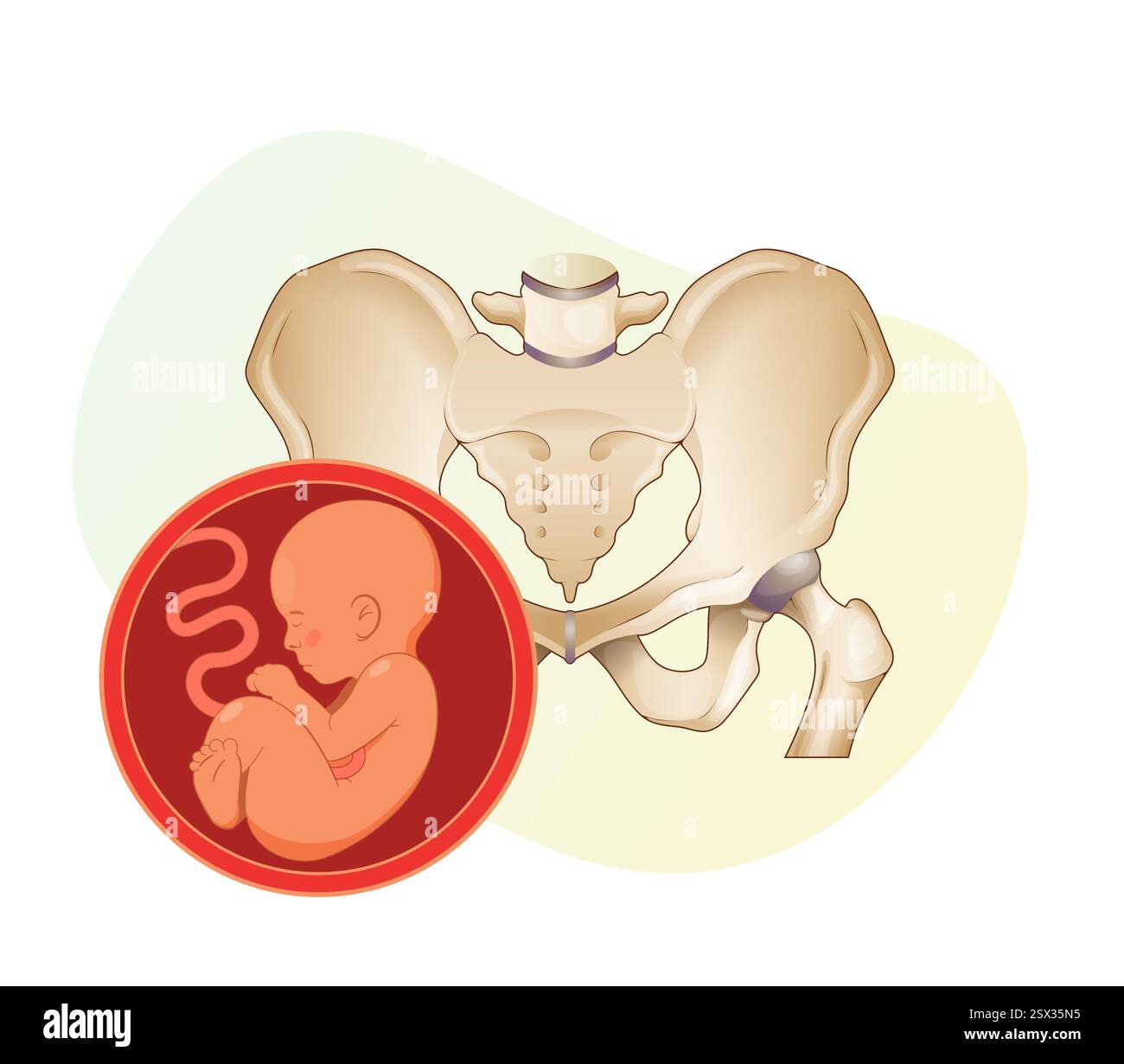 Schwangerschaftsherausforderungen mit Cephalopelvic Disroportion – Stock Illustration als EPS 10 File Stock Vektor