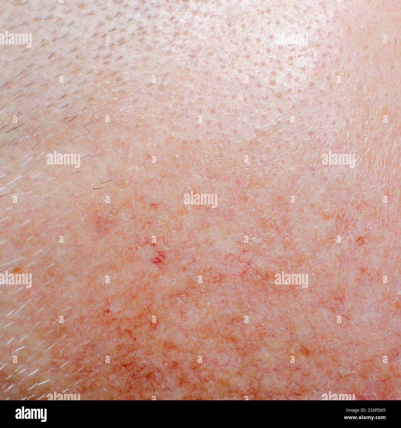 Aktinische Keratose oder Basalzellkarzinom auf der Kopfhaut eines Erwachsenen Stockfoto