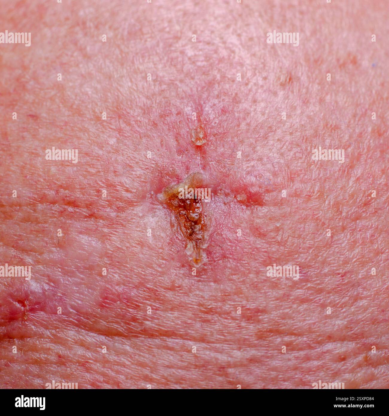 Faszinierend Weisser Hautkrebs Fotos Bildernull