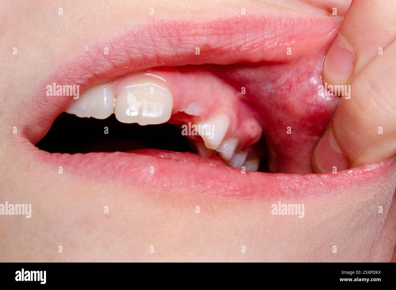 Zahnfleischerkrankung und Karies bei einem Kind Stockfoto