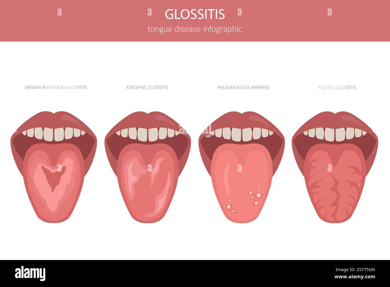 Glossitis-Zungenkrankheit. Orale Medizin. Medizinische Infografik. Vektorabbildung Stock Vektor