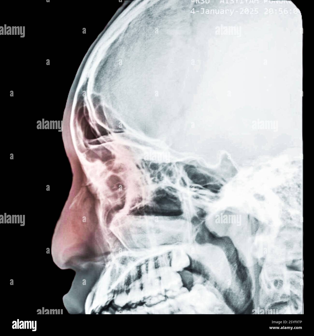 Farbiges Röntgenbild des Kopfes eines Patienten mit gebrochener Nase. Stockfoto