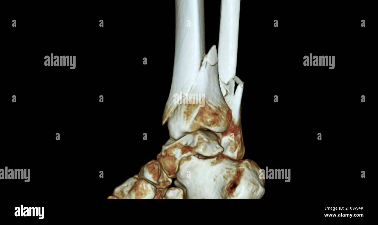 CT Scan 3D-Rendering-Bild mit Frakturen an Tibia und Fibula ...