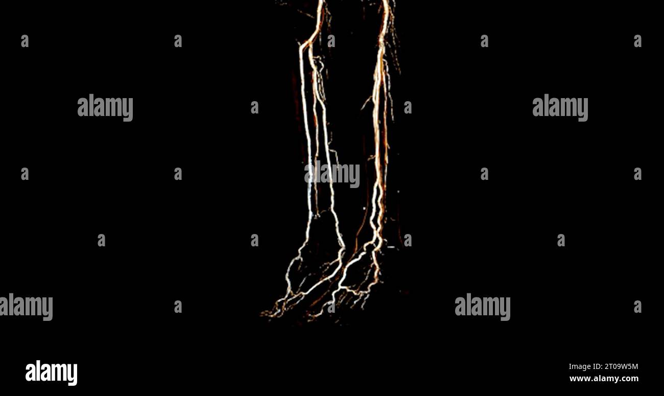 CTA-Bild der Arteria femoralis bei diagnostischer akuter oder chronischer peripherer arterieller Erkrankung. Stockfoto