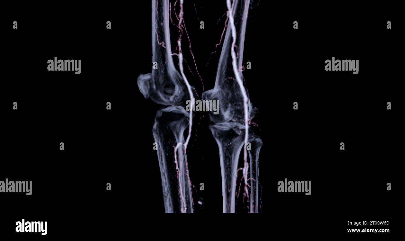 CTA-Bild der Arteria femoralis bei diagnostischer akuter oder chronischer peripherer arterieller Erkrankung. Stockfoto