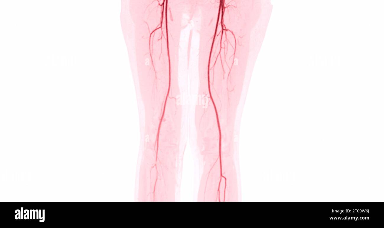 CTA-Bild der Arteria femoralis bei diagnostischer akuter oder chronischer peripherer arterieller Erkrankung. Stockfoto