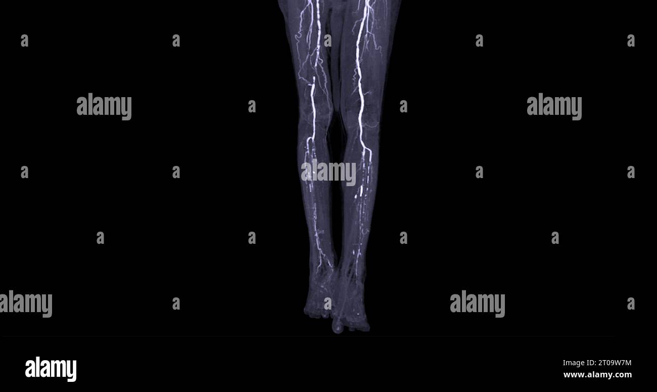 CTA-Bild der Arteria femoralis bei diagnostischer akuter oder chronischer peripherer arterieller Erkrankung. Stockfoto