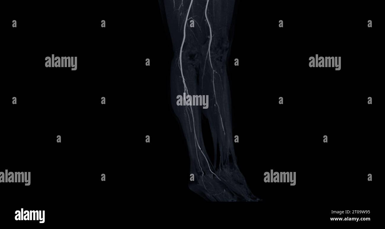 CTA-Bild der Arteria femoralis bei diagnostischer akuter oder chronischer peripherer arterieller Erkrankung. Stockfoto