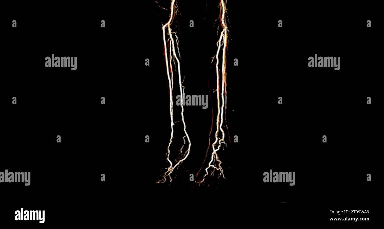 CTA-Bild der Arteria femoralis bei diagnostischer akuter oder chronischer peripherer arterieller Erkrankung. Stockfoto