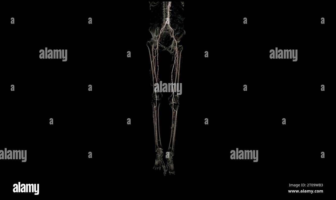 CTA-Bild der Arteria femoralis bei diagnostischer akuter oder chronischer peripherer arterieller Erkrankung. Stockfoto