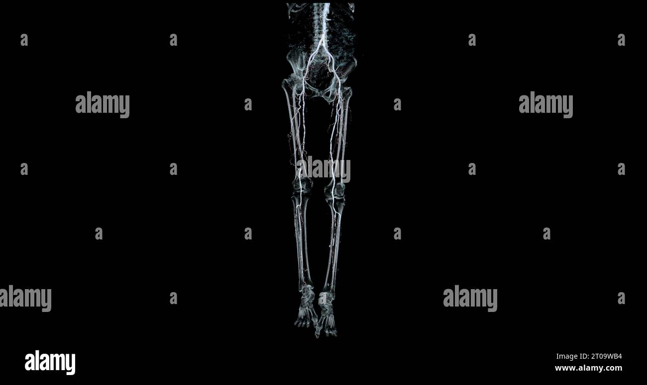 CTA-Bild der Arteria femoralis bei diagnostischer akuter oder chronischer peripherer arterieller Erkrankung. Stockfoto