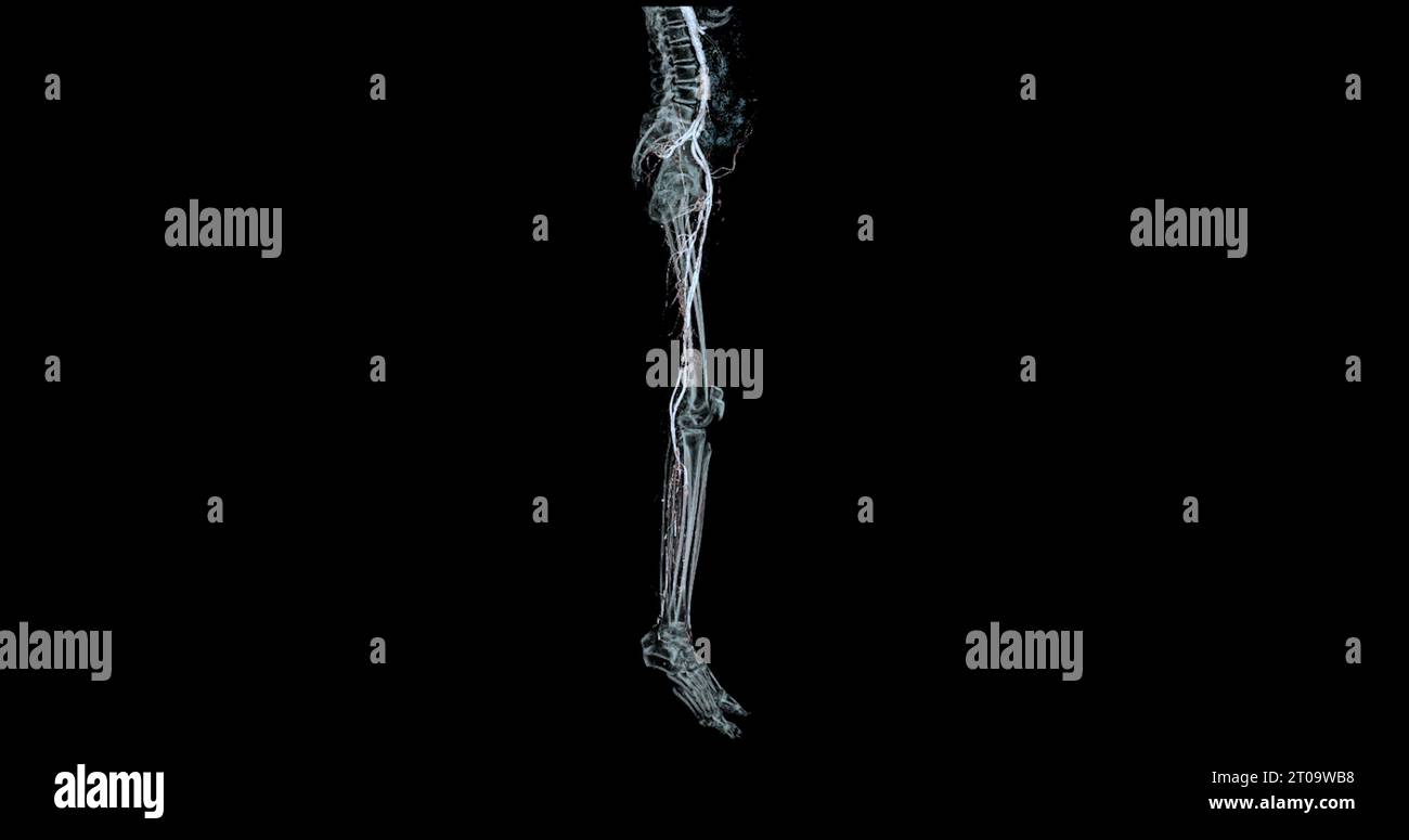 CTA-Bild der Arteria femoralis bei diagnostischer akuter oder chronischer peripherer arterieller Erkrankung. Stockfoto