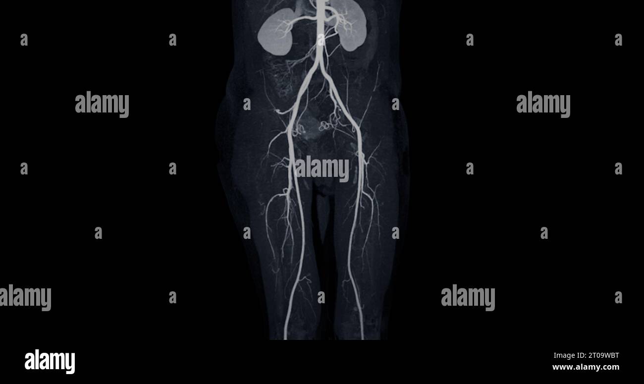 CTA-Bild der Arteria femoralis bei diagnostischer akuter oder chronischer peripherer arterieller Erkrankung. Stockfoto