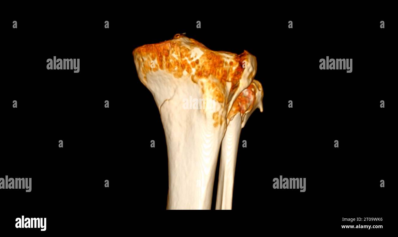 CT-Scan des Kniegelenkes mit 3D-Rendering von Tibia- und Fibulaknochen-Frakturen. Stockfoto