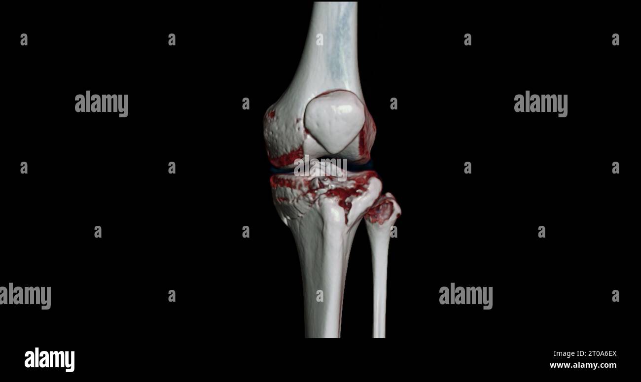 CT-Scan des Kniegelenkes mit 3D-Rendering von Tibia- und Fibulaknochen-Frakturen. Stockfoto