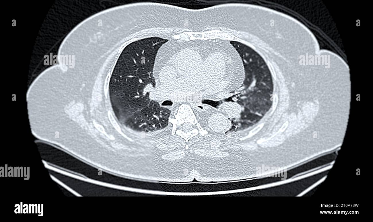 CT-Scan der axialen Thoraxansicht bei diagnostischer Lungenembolie (PE), Lungenkrebs und covid-19. Stockfoto