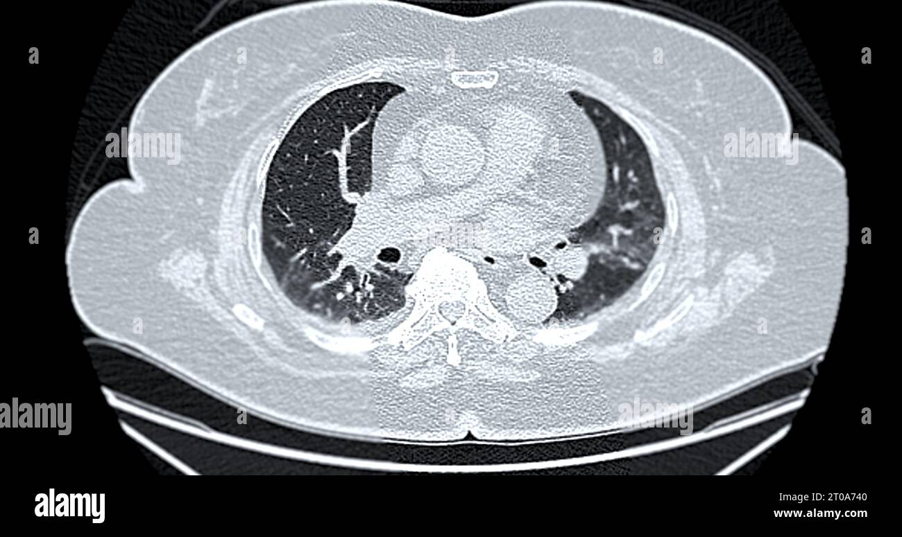 CT-Scan der axialen Thoraxansicht bei diagnostischer Lungenembolie (PE), Lungenkrebs und covid-19. Stockfoto