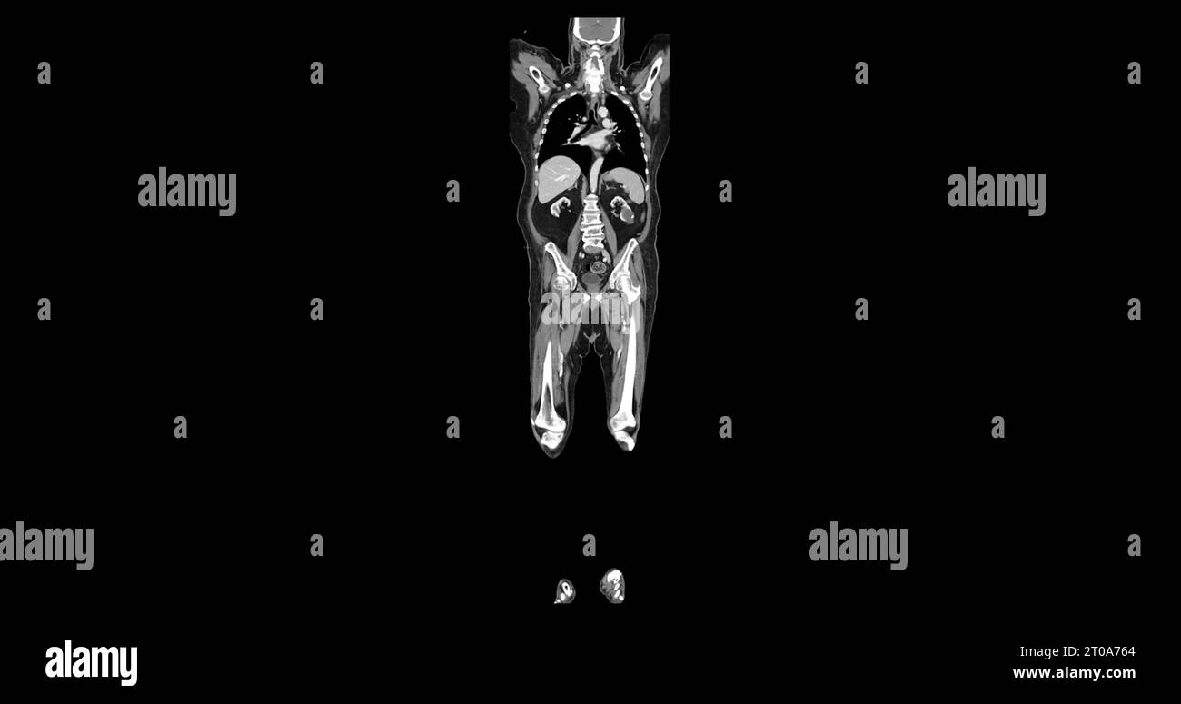 CT-Scan des Ganzkörpers mit Kontrastmittel zur Injektion koronaler Ansicht zur Diagnose von Brust- und Bauchschmerzen. Stockfoto