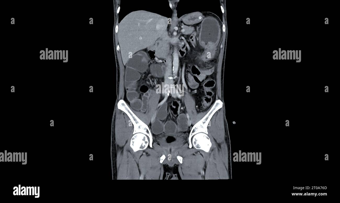 CT Brust und Abdomen mit koronaler Kontrastmittelinjektion zur Diagnose von Brust- und Abdominalschmerzen. Stockfoto