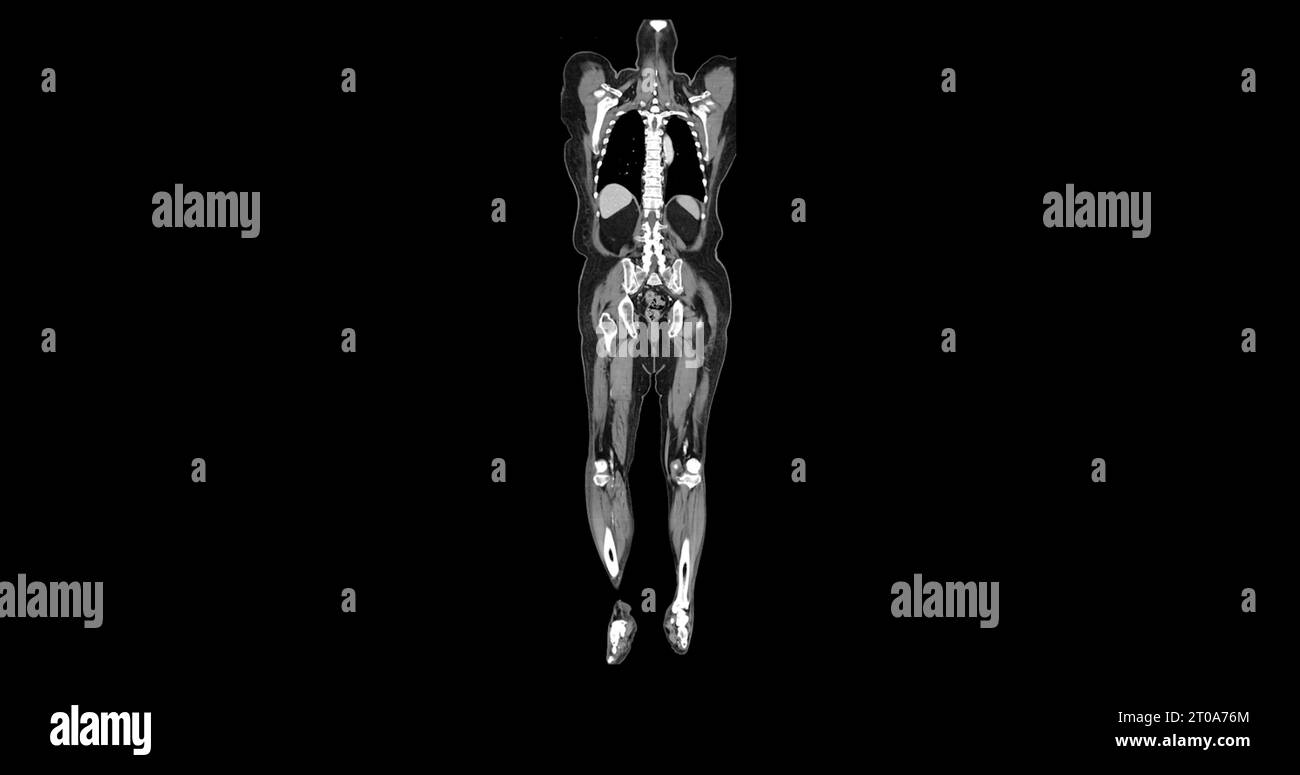 CT-Scan des Ganzkörpers mit Kontrastmittel zur Injektion koronaler Ansicht zur Diagnose von Brust- und Bauchschmerzen. Stockfoto