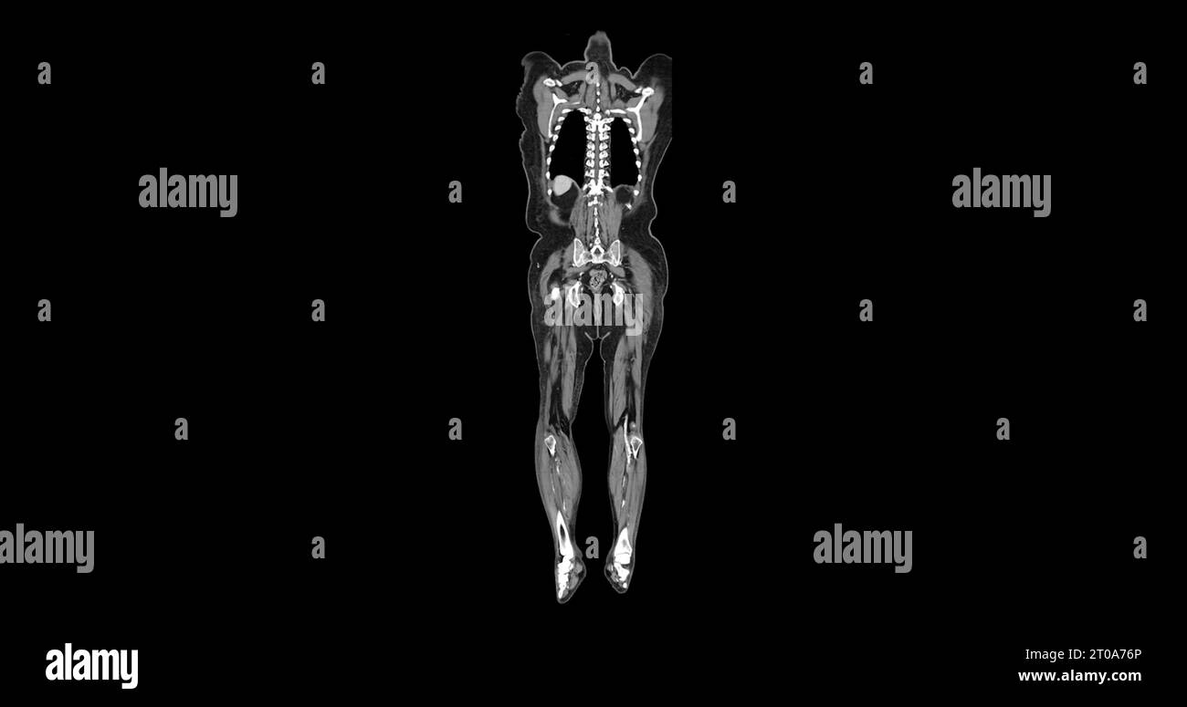 CT-Scan des Ganzkörpers mit Kontrastmittel zur Injektion koronaler Ansicht zur Diagnose von Brust- und Bauchschmerzen. Stockfoto