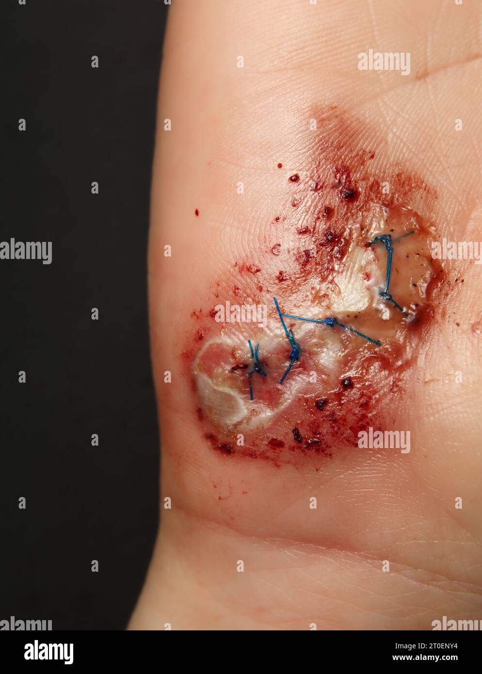 Genähte Handrisse nach dem Sturz. Weibliche Hand mit genähter Wunde im frühen Heilstadium. 3