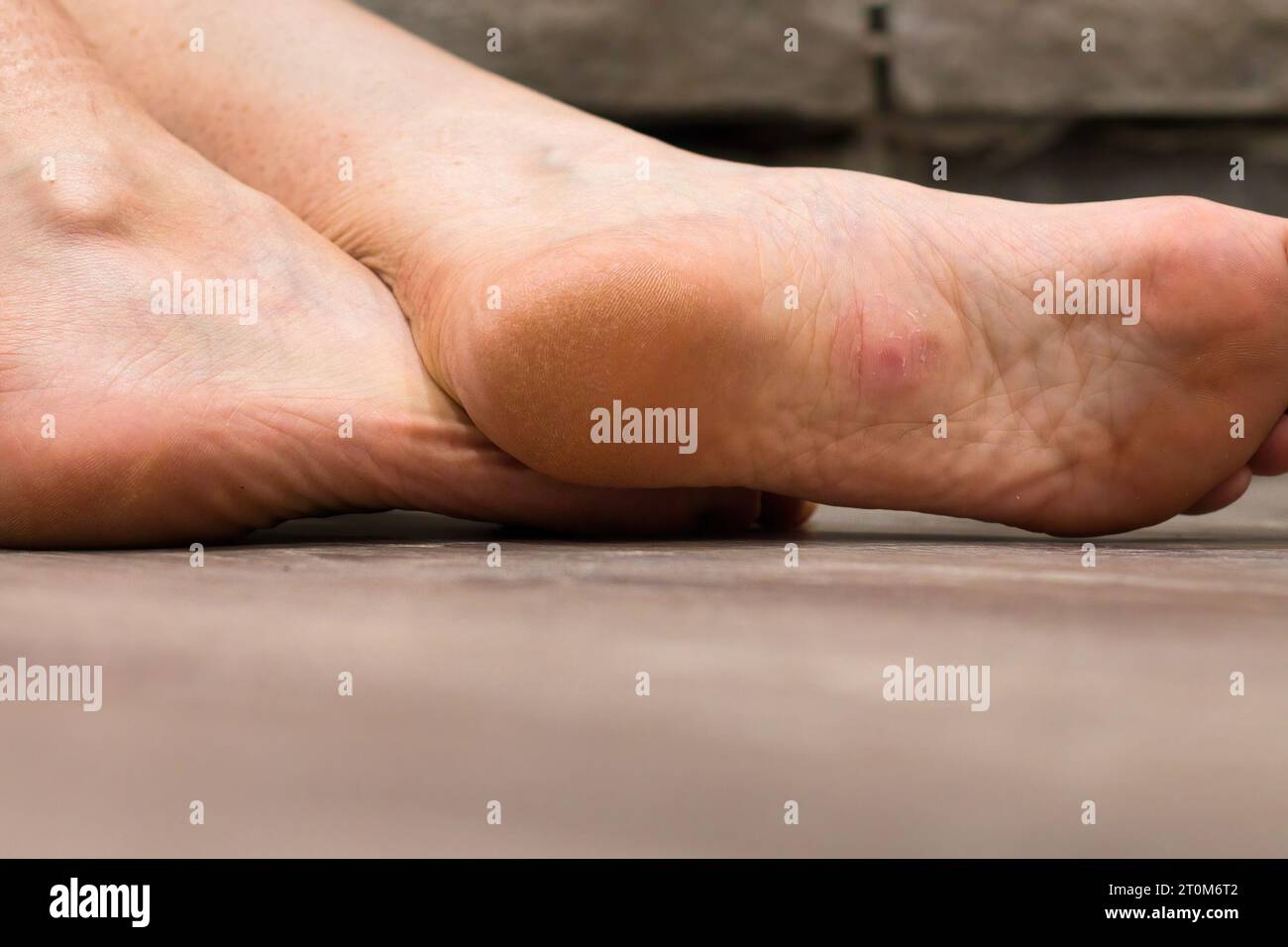 Rosa Haut auf einer Warze auf der Fußsohle auf einem Holzboden. Stockfoto