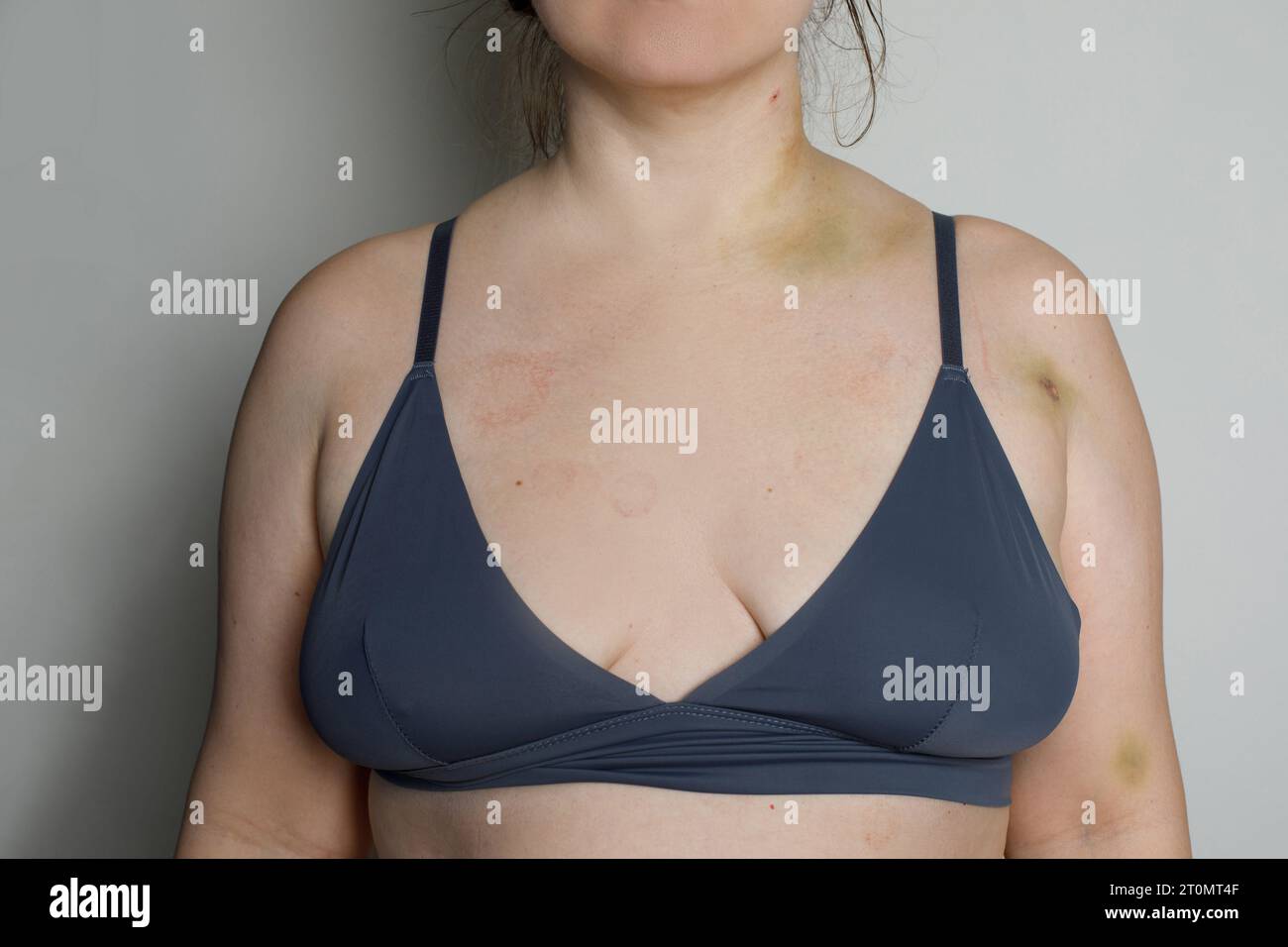 Blutergüsse auf der weiblichen Haut. Injektionsergüsse nach Lungenembolie Stockfoto