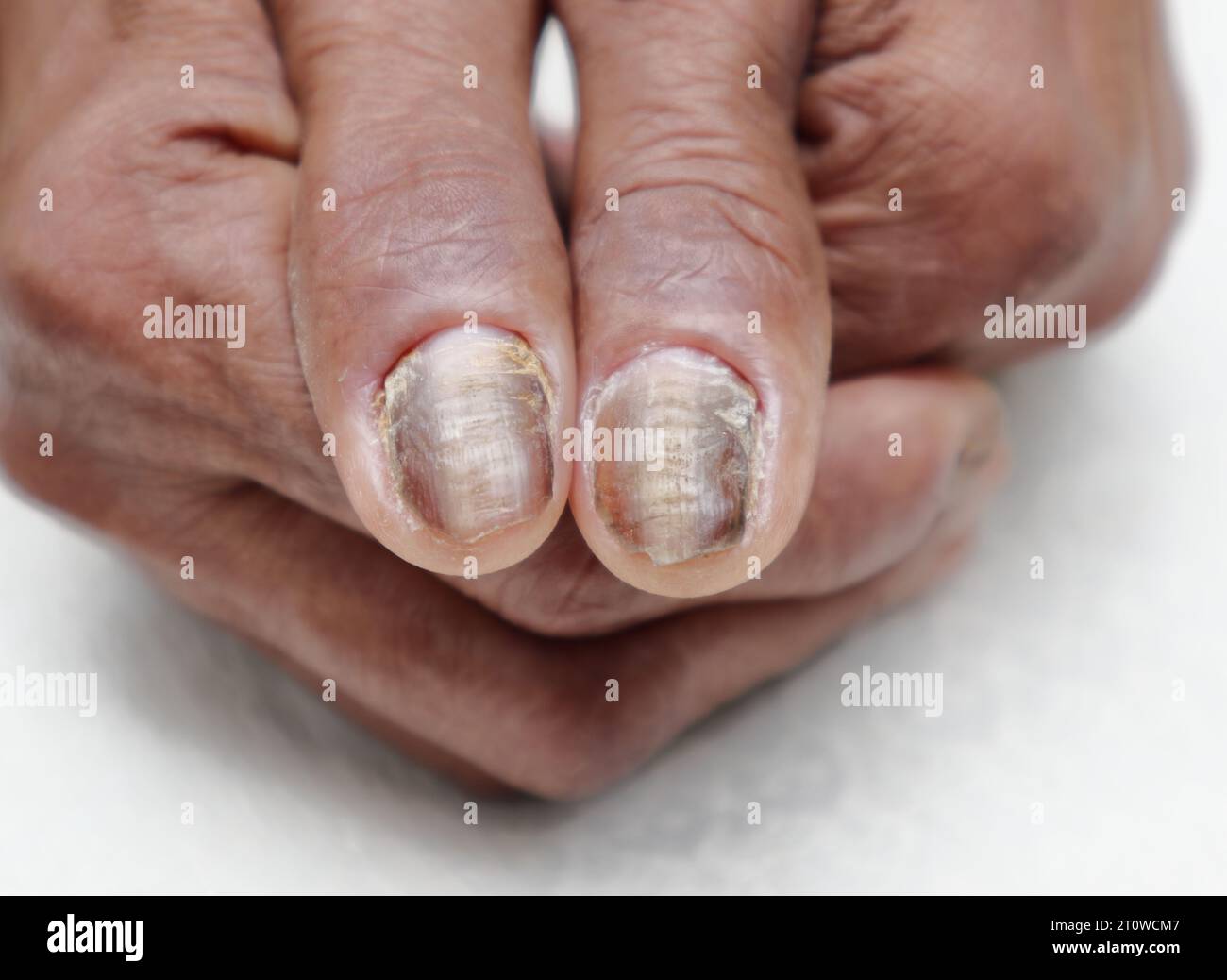 Nahaufnahme der verwöhnten Handnägel einer älteren asiatischen Diabetikerin Stockfoto