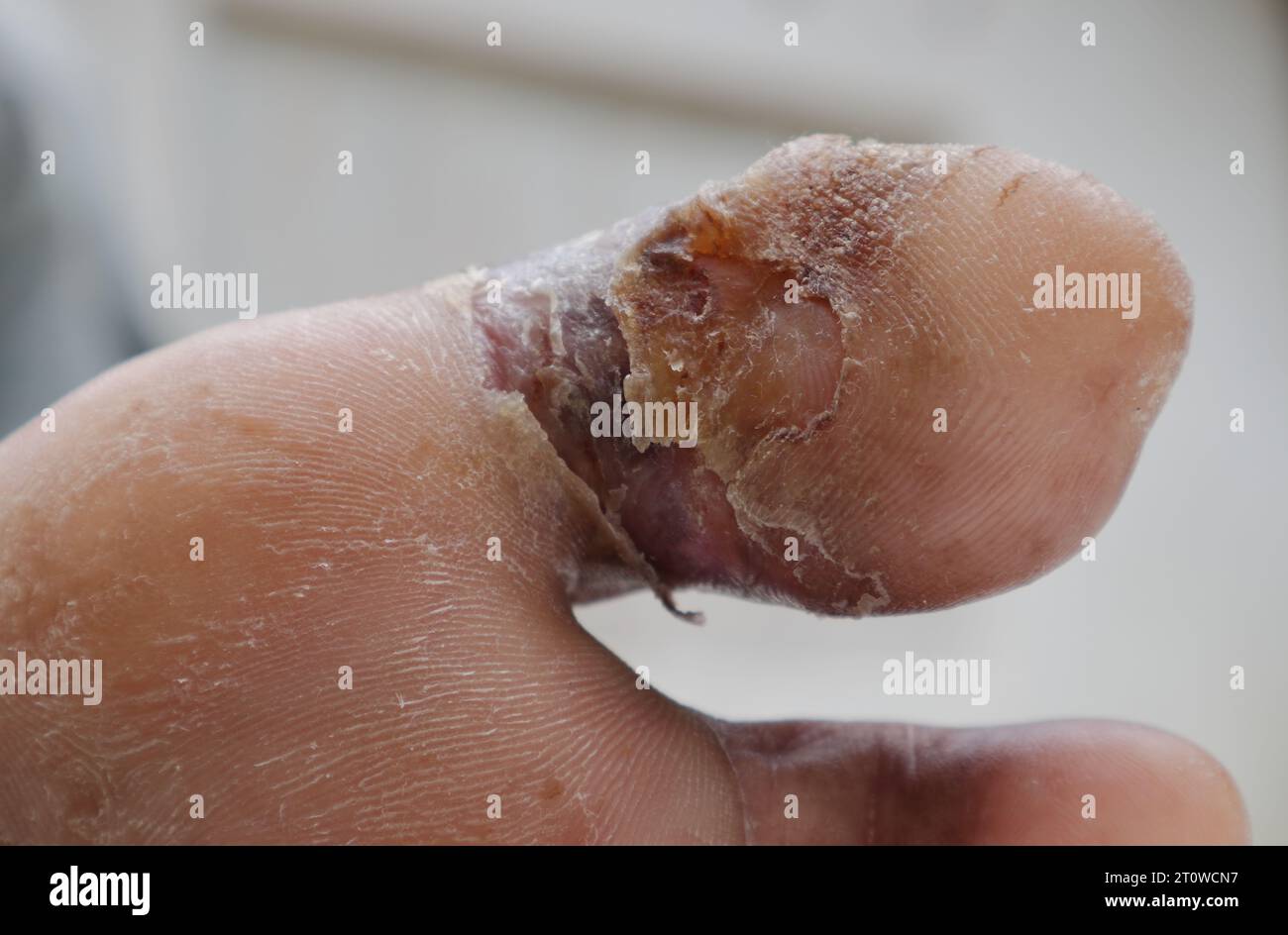 Ein diabetisches Fußulkus in einem großen Zeh heilt langsam aus der Nähe Stockfoto