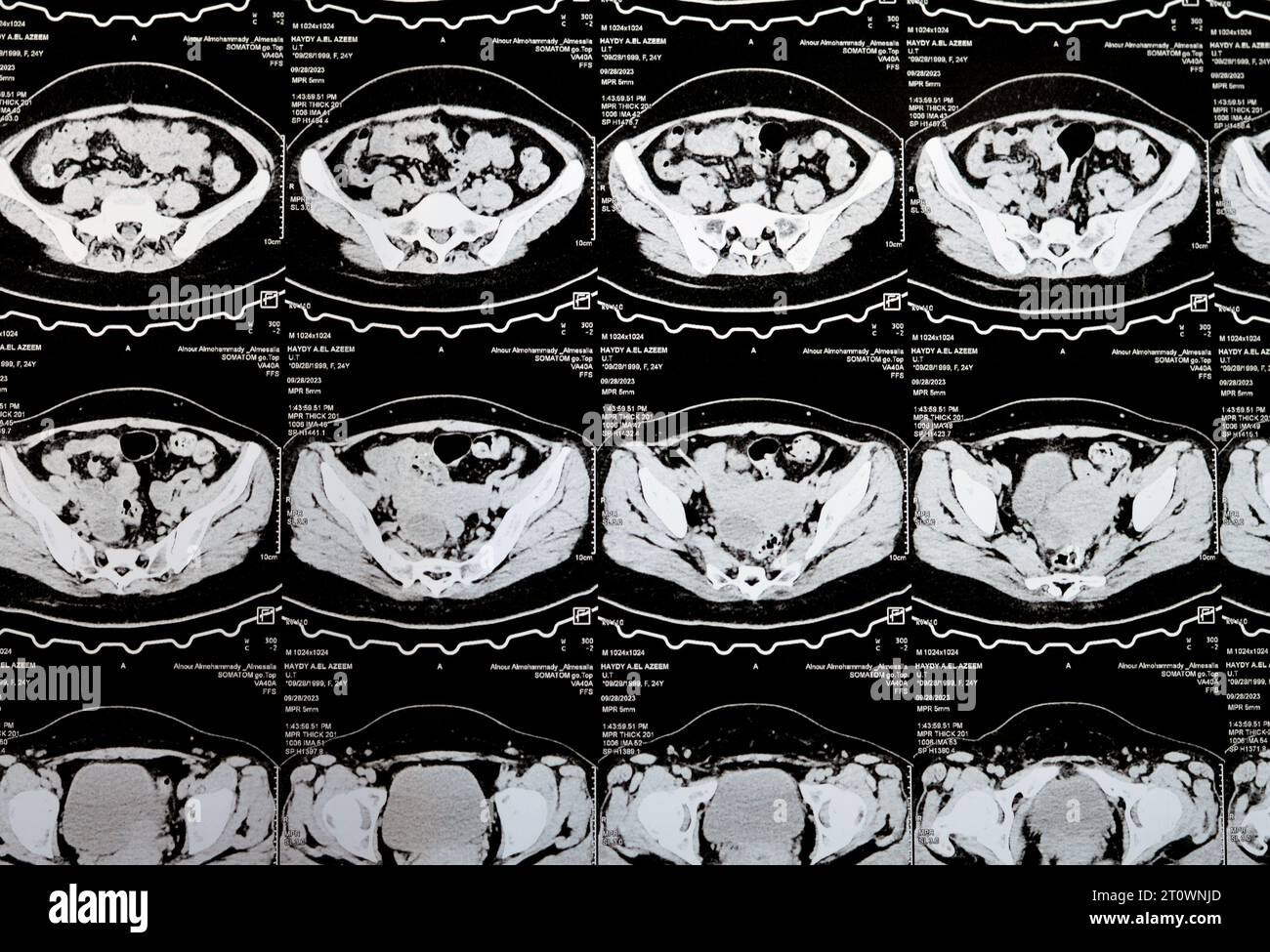 Kairo, Ägypten, 3. Oktober 2023: Mehrschicht-CT-Scan Abdomen und Becken zeigt rechte Ovarialzyste 3 x 3 cm, gasförmige Distension des Kolons, keine nennenswerte Harnmenge Stockfoto
