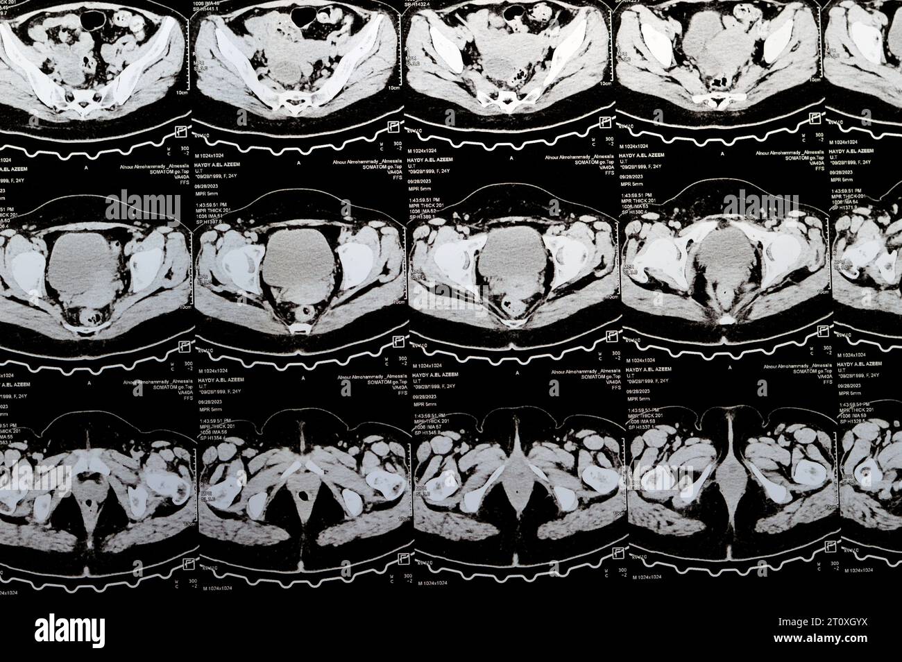 Kairo, Ägypten, 3. Oktober 2023: Mehrschicht-CT-Scan Abdomen und Becken zeigt rechte Ovarialzyste 3 x 3 cm, gasförmige Distension des Kolons, keine nennenswerte Harnmenge Stockfoto