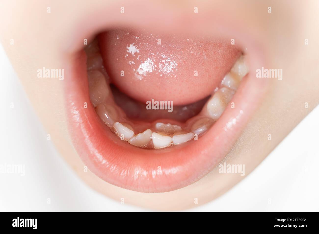 Krumm wachsende Zähne als Ersatz für Milchzähne bei einem Kind. In der zweiten Zahnreihe wächst der Zahn, während der Schneidezahn noch nicht herausgefallen ist. Stockfoto