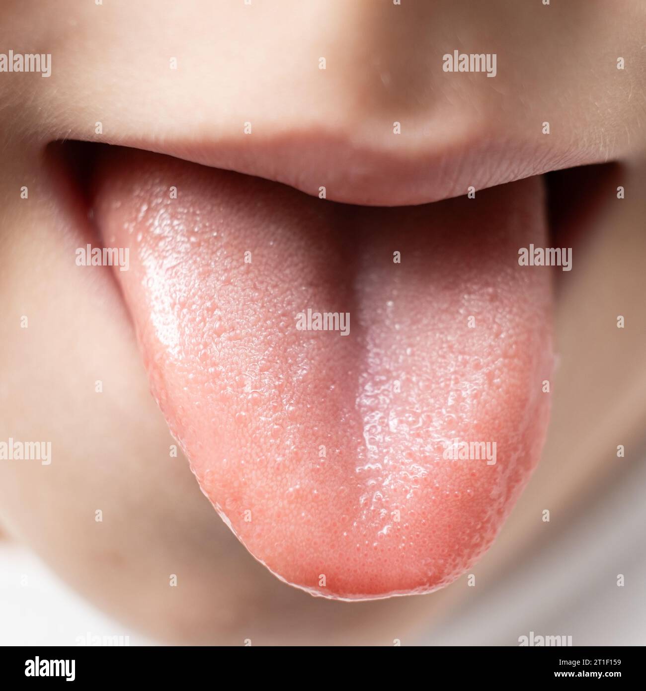 Die Zunge eines sechsjährigen gesunden Kindes, Papillen auf der Zunge Stockfoto