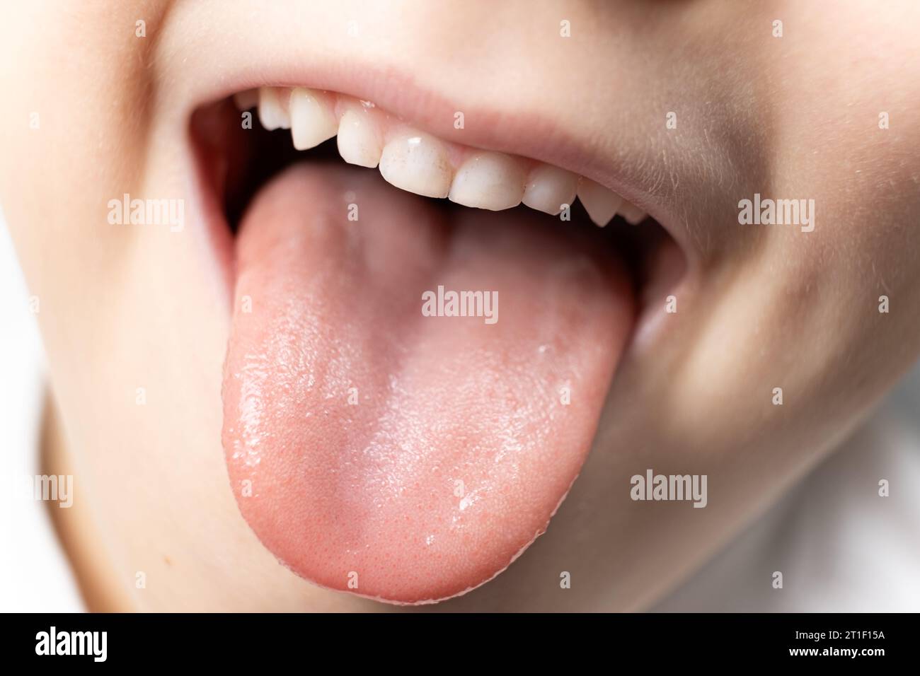 Die Zunge eines sechsjährigen gesunden Kindes, Papillen auf der Zunge Stockfoto