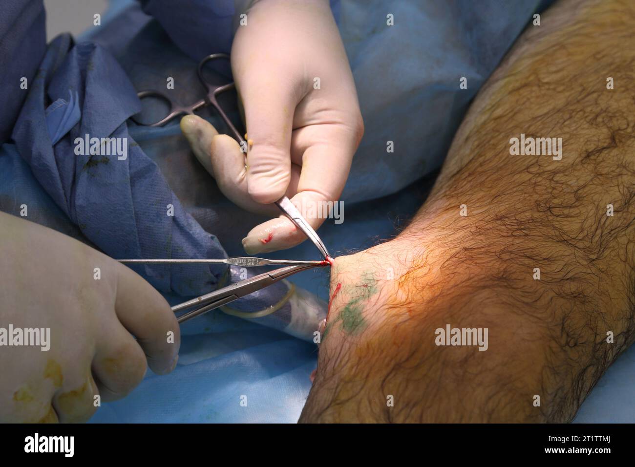 Medizinische Chirurgie bei endovenöser Laserphotokoagulation der Vena saphena magna. Miniphlegektomie. Endovenöse Lasergerinnungsvene. Stockfoto