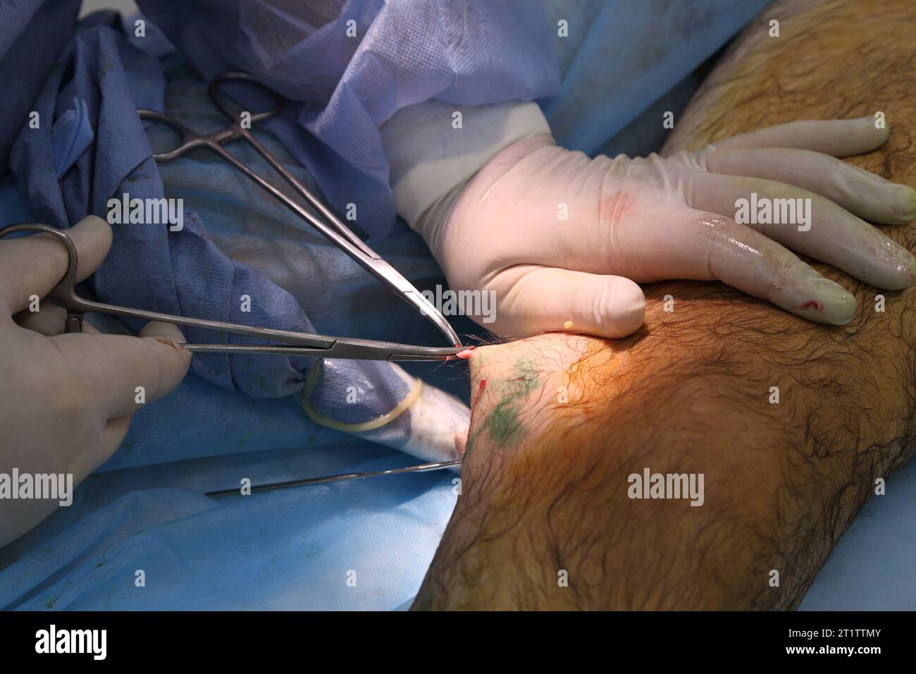 Medizinische Chirurgie bei endovenöser Laserphotokoagulation der Vena saphena magna. Miniphlegektomie. Endovenöse Lasergerinnungsvene. Stockfoto