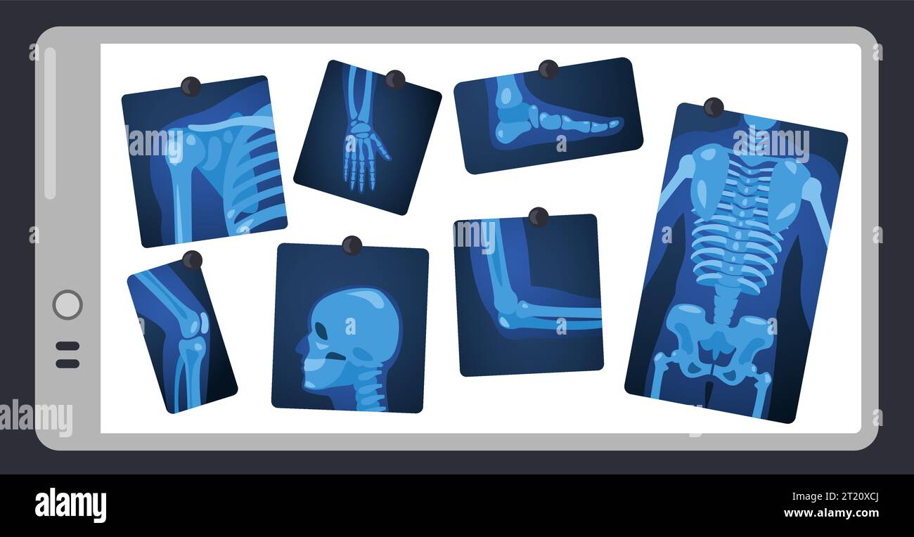 Röntgen auf dem Arztbild. Menschliche Skelettteile auf chirurgischem Lichtpolster, Körperteilmedizinisches Röntgenkonzept. Vektorabbildung Stock Vektor