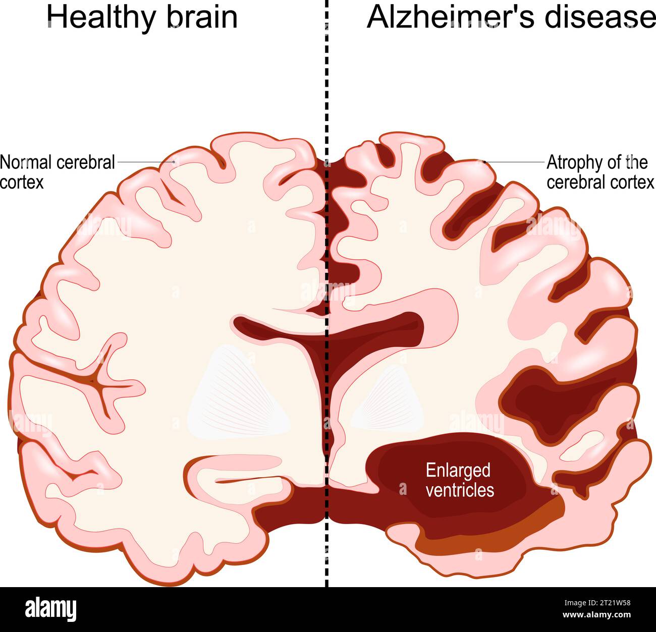 Menschliches Gehirn in zwei Hälften: Gesund und Alzheimer-Krankheit. Neurodegenerative Störung. Demenz. Gedächtnisverlust und kognitiver Rückgang. Querschnitt von Stock Vektor
